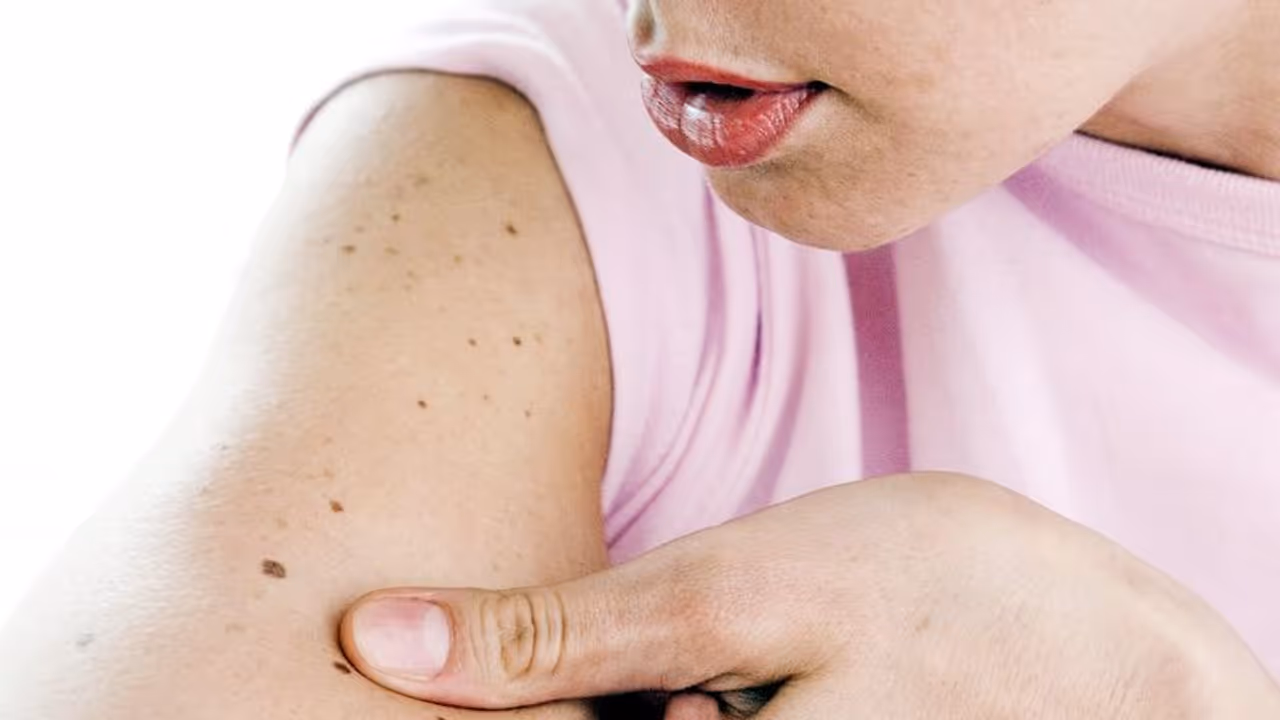 skin cancer| സ്കിൻ കാൻസറിനെ പ്രതിരോധിക്കാൻ ഈ പഴം മികച്ചത്;​ ​ഗവേഷകർ പറയുന്നത്...