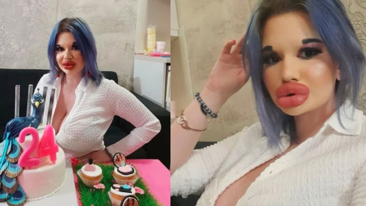 दुनिया में सबसे बड़े होंठ: डॉल की तरह दिखने के चक्कर में लाखों रु खर्च किए, होंठ इतना बड़ा हुआ कि फटने का डर दुनिया में सबसे बड़े होंठ: डॉल की तरह दिखने के चक्कर में लाखों रु खर्च किए, होंठ इतना बड़ा हुआ कि फटने का डर