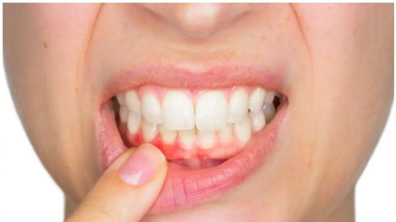 മോണയില്‍ നിന്ന് രക്തം, പെട്ടെന്ന് മുറിവോ ചതവോ പറ്റുന്നത്; കാരണം ഇതാകാം...