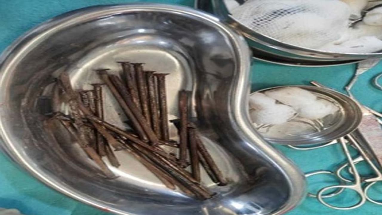 OMG: 17 के लड़के ने रोटी की तरह खा लीं 27 कीलें, डॉक्टर अल्ट्रासाउंड देख हैरान..बोले ये अभी तक जिंदा कैसे? OMG: 17 के लड़के ने रोटी की तरह खा लीं 27 कीलें, डॉक्टर अल्ट्रासाउंड देख हैरान..बोले ये अभी तक जिंदा कैसे?