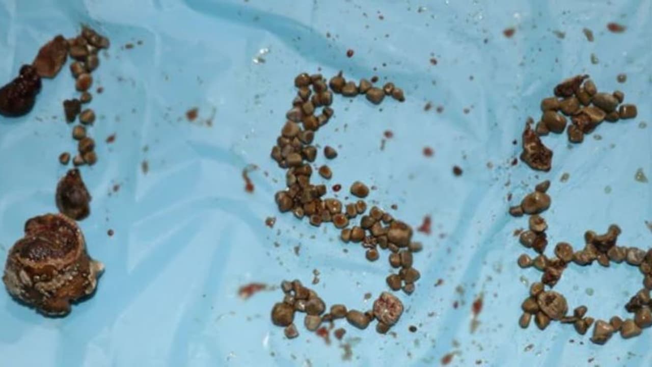 Record Kidney Stones: দেশে এই প্রথম, ল্যাপ্রোস্কোপির মাধ্যমে কিডনি থেকে বেরোল ১৫৬টি স্টোন Record Kidney Stones: দেশে এই প্রথম, ল্যাপ্রোস্কোপির মাধ্যমে কিডনি থেকে বেরোল ১৫৬টি স্টোন