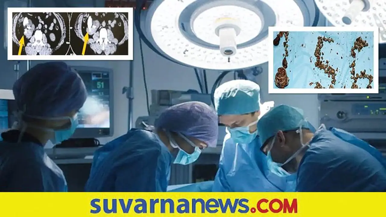 ಇದೆಂತಾ ಅಚ್ಚರಿ.! ವ್ಯಕ್ತಿಯ ದೇಹದಲ್ಲಿದ್ದ Kidney Stone ಕಂಡು ವೈದ್ಯರಿಗೇ ಶಾಕ್! ಇದೆಂತಾ ಅಚ್ಚರಿ.! ವ್ಯಕ್ತಿಯ ದೇಹದಲ್ಲಿದ್ದ Kidney Stone ಕಂಡು ವೈದ್ಯರಿಗೇ ಶಾಕ್!