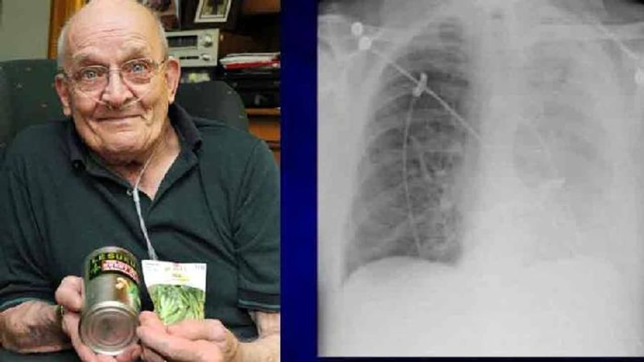 Pea plant in lung : മനുഷ്യന്റെ ശരീരത്തിൽ ചെടി വളരുമോ? 75 കാരന്റെ ശ്വാസകോശത്തിൽ പയറുചെടി വളര്ന്ന കഥ! Pea plant in lung : മനുഷ്യന്റെ ശരീരത്തിൽ ചെടി വളരുമോ? 75 കാരന്റെ ശ്വാസകോശത്തിൽ പയറുചെടി വളര്ന്ന കഥ!