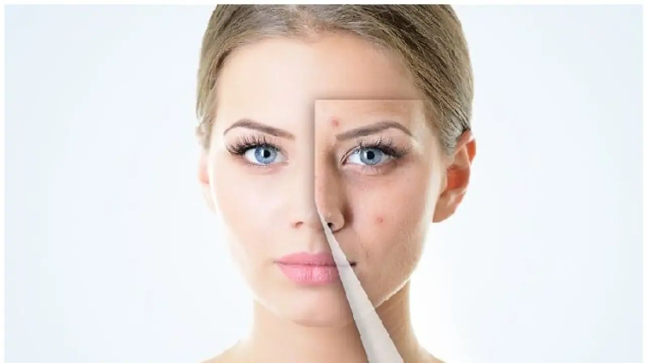 Pimple Marks Cure : മുഖക്കുരുവിന്റെ പാടുകൾ അകറ്റാൻ ഇതാ നാല് സിമ്പിൾ ടിപ്സ്