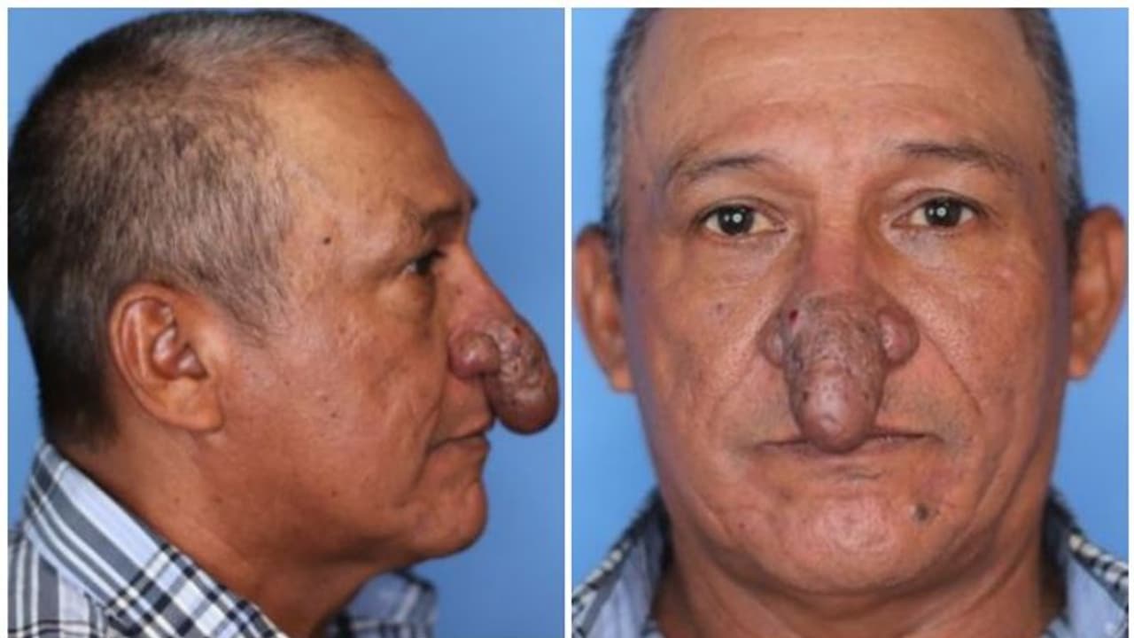 Penis Shaped Nose : ലിംഗാകൃതിയിലുള്ള മൂക്ക്; ഭക്ഷണം കഴിക്കാൻ ബുദ്ധിമുട്ടി, ഒടുവിൽ ശസ്ത്രക്രിയ ചെയ്തു