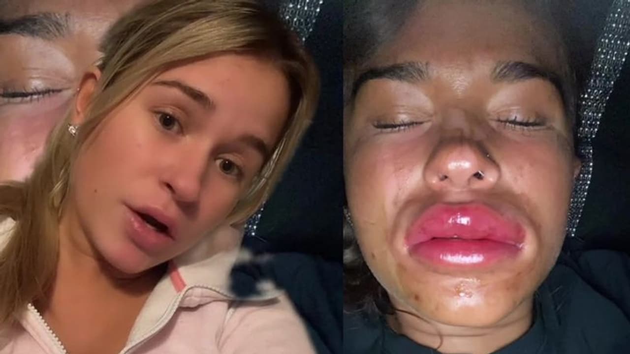 होंठ 3 गुना ज्यादा बड़े होने पर डर गई लड़की, जानें क्यों कहा मैंने अब तक का सबसे बुरा काम किया