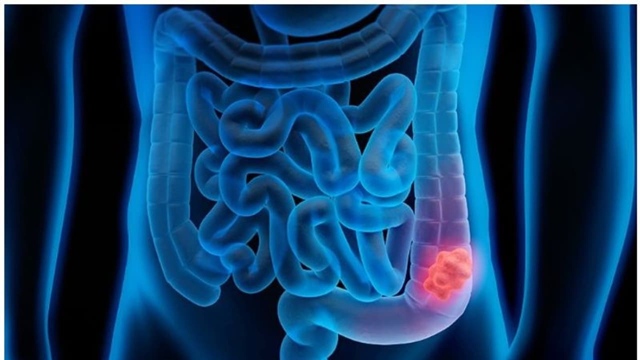 Cancer Symptoms : ചെറുപ്പക്കാരില് ഈ അര്ബുദം കൂടിവരുന്നു; ലക്ഷണങ്ങളും കാരണങ്ങളും അറിയാം Cancer Symptoms : ചെറുപ്പക്കാരില് ഈ അര്ബുദം കൂടിവരുന്നു; ലക്ഷണങ്ങളും കാരണങ്ങളും അറിയാം