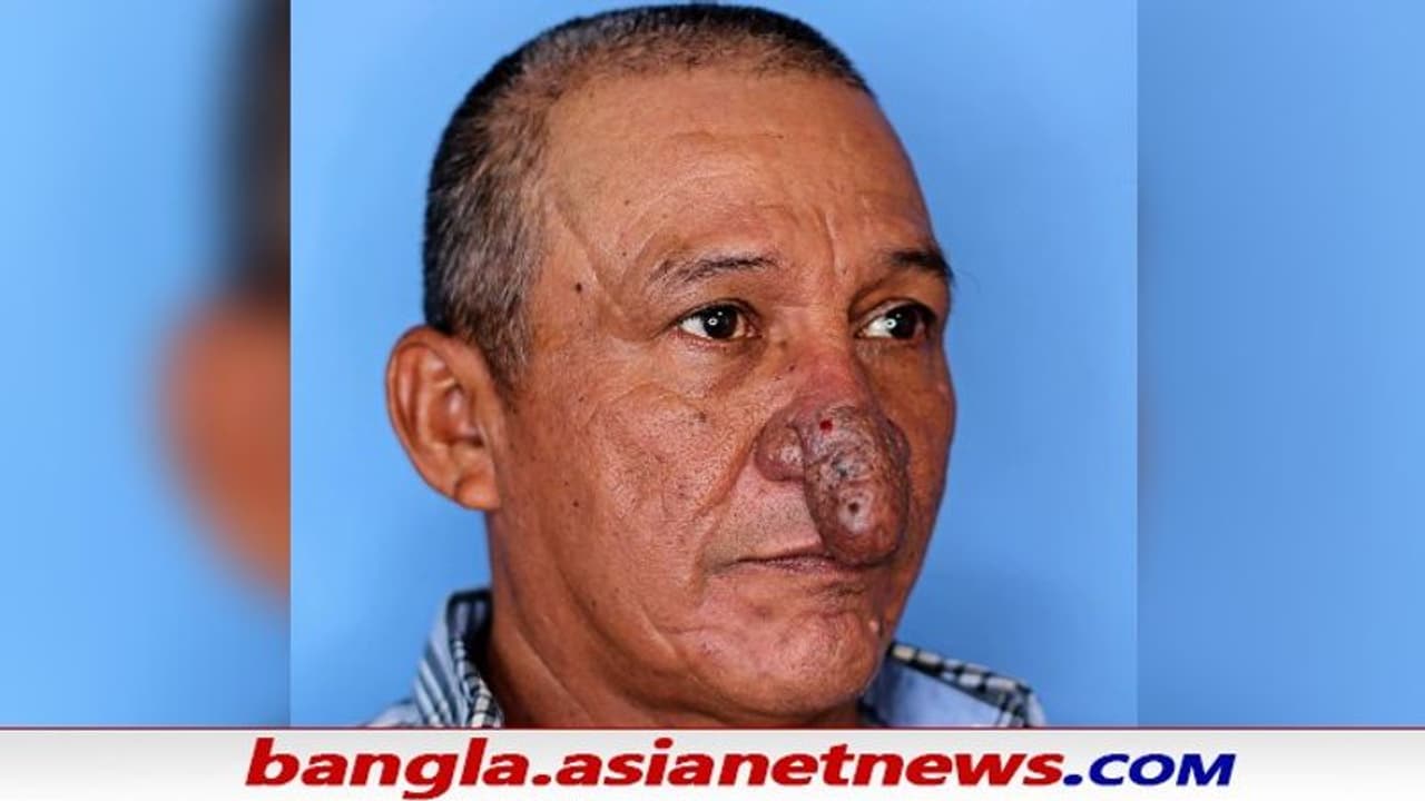 New Nose as Christmas Gift: ক্রিসমাসে 'নাক' উপহার দিল দেবদূত, ভাইরাল কাহিনি