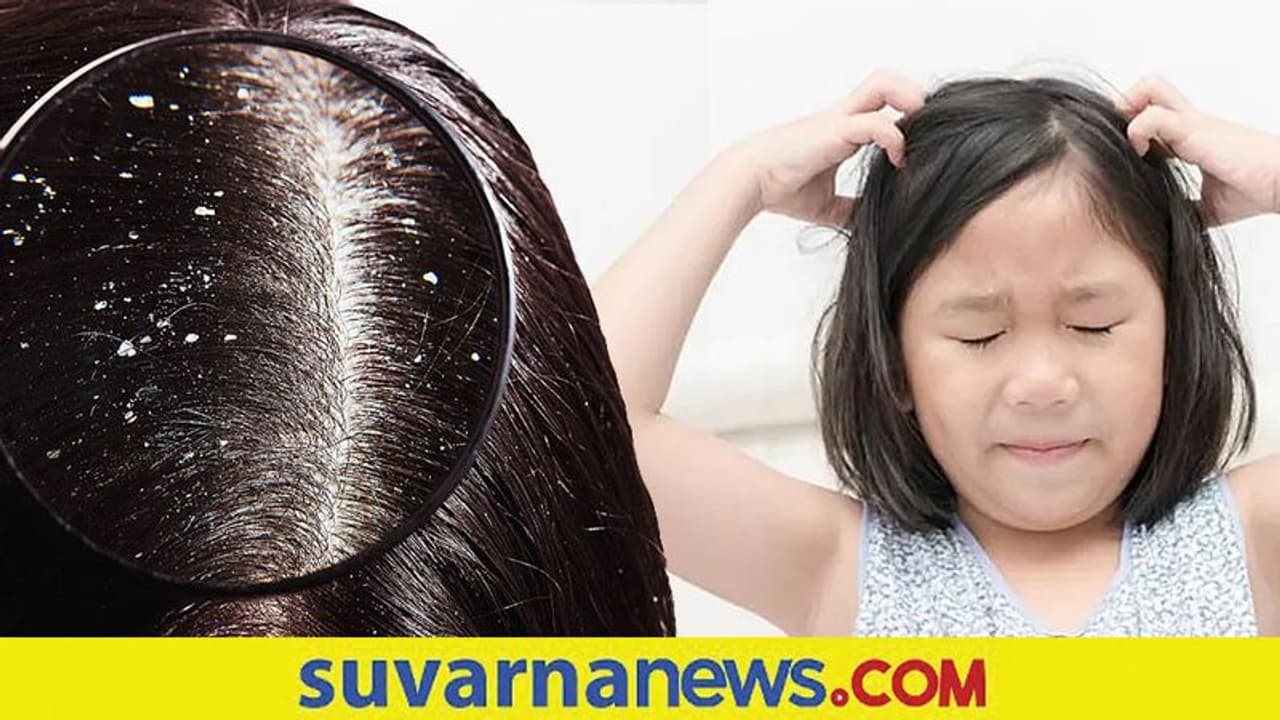 Dandruff : ಆಗಾಗ ತಲೆ ತುರಿಸಿಕೊಳ್ಳುವ ಮಕ್ಕಳ ಬಗ್ಗೆ ನಿರ್ಲಕ್ಷ್ಯ ಬೇಡ