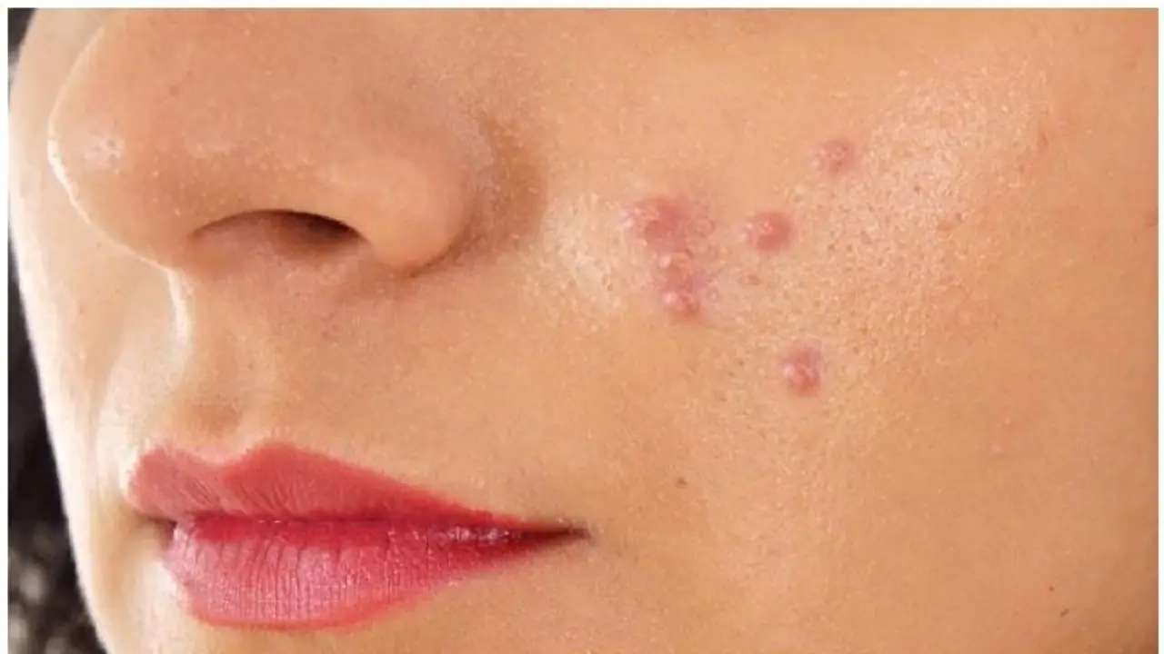 Acne Treatment : മുഖക്കുരു മാറാൻ വീട്ടില്‍ പരീക്ഷിക്കാവുന്ന ഒരു പൊടിക്കൈ