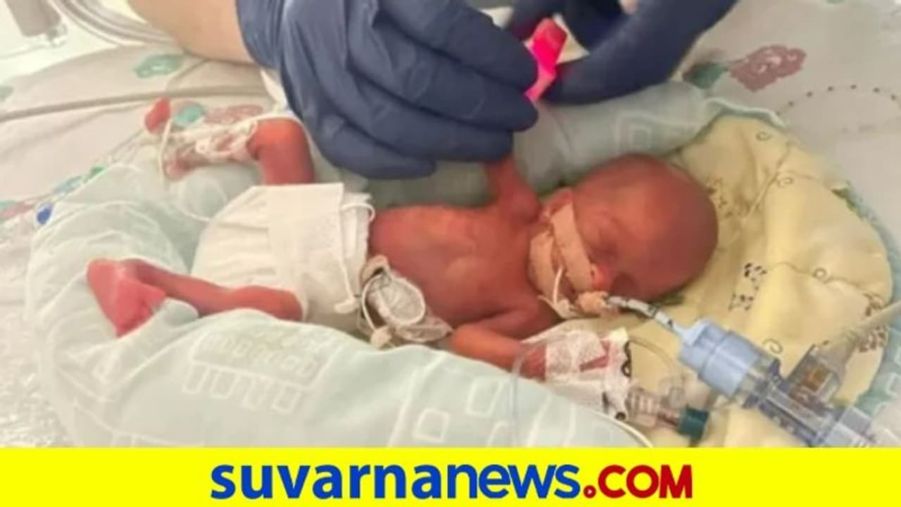 325 ಗ್ರಾಂ ತೂಕದ ಅತ್ಯಂತ ಸಣ್ಣ ಮಗುವಿಗೆ ಜನ್ಮ ನೀಡಿದ 17ರ ಬಾಲೆ