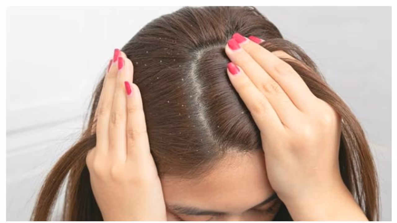 பொடுகை விரட்ட செயற்கை மருந்து தேவையா? வீட்டில் இருக்கும் 7 அற்புத இயற்கை வழிகள்!