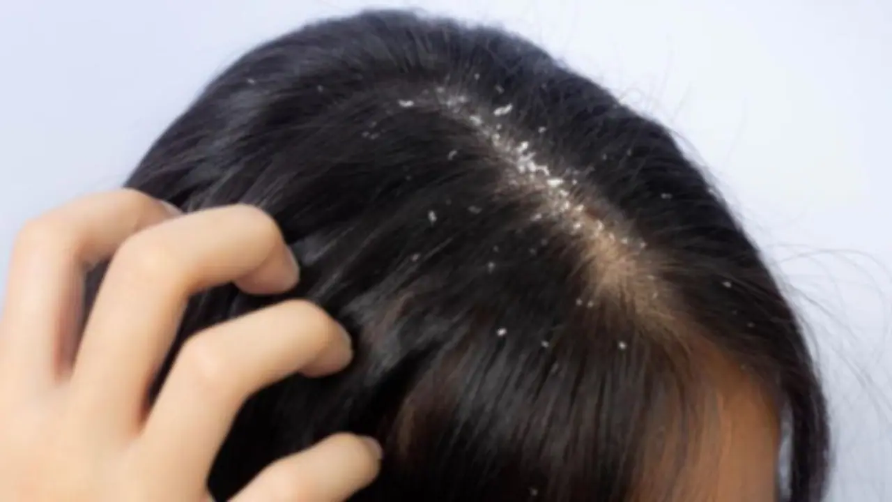 Dandruff and Hairfall : മഴക്കാലത്ത് താരനും മുടി കൊഴിച്ചിലും കൂടുമോ? 