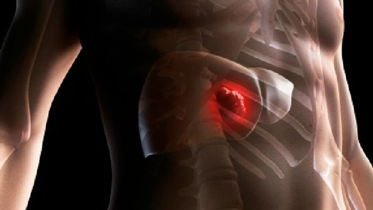 உடலில் இந்த அறிகுறிகள் இருந்தால் அசால்டாக இருக்காதீங்க..! அது கல்லீரல் புற்றுநோயாக இருக்கலாம்..!!