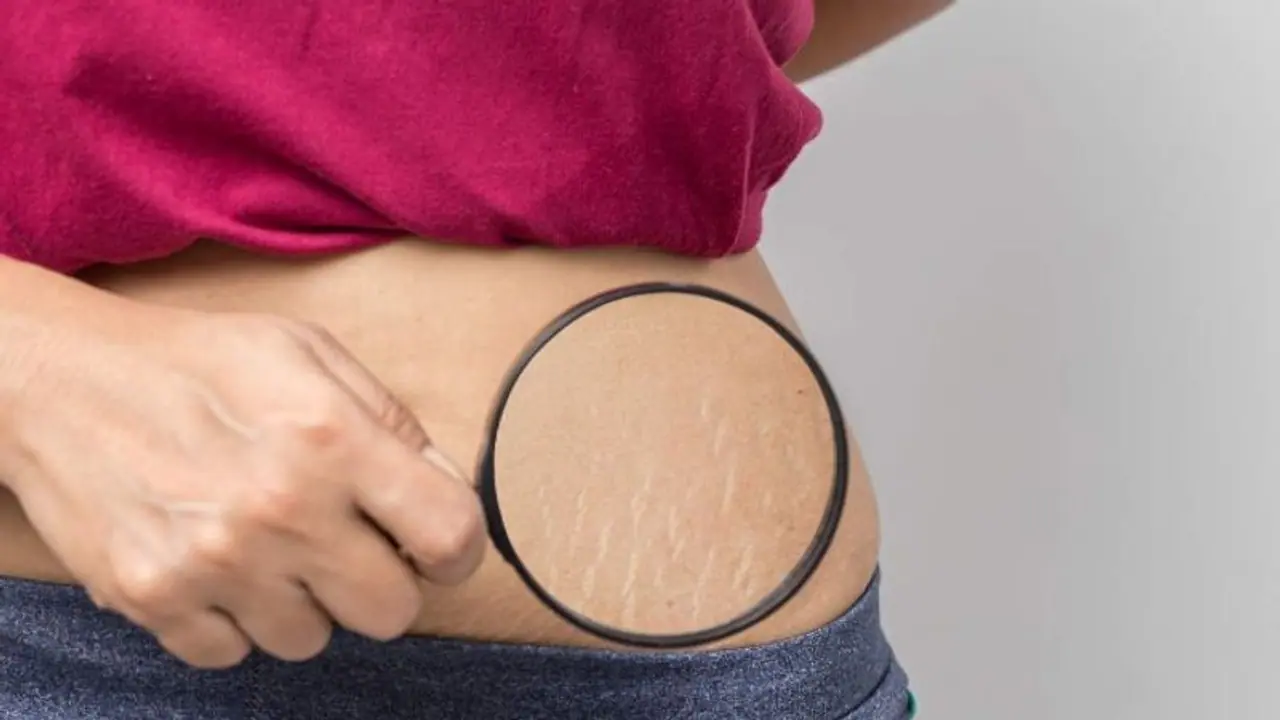 Stretch Marks: പ്രസവശേഷമുളള സ്ട്രെച്ച് മാർക്ക് മാറാൻ പരീക്ഷിക്കാം ഈ എളുപ്പ വഴികൾ...