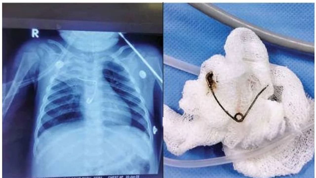 സേഫ്റ്റിപിന് അന്നനാളത്തില് കുടുങ്ങി പിഞ്ചുകുഞ്ഞ്; ജീവന് തിരിച്ചുപിടിച്ച് തൃശൂര് മെഡിക്കല് കോളേജ് സേഫ്റ്റിപിന് അന്നനാളത്തില് കുടുങ്ങി പിഞ്ചുകുഞ്ഞ്; ജീവന് തിരിച്ചുപിടിച്ച് തൃശൂര് മെഡിക്കല് കോളേജ്