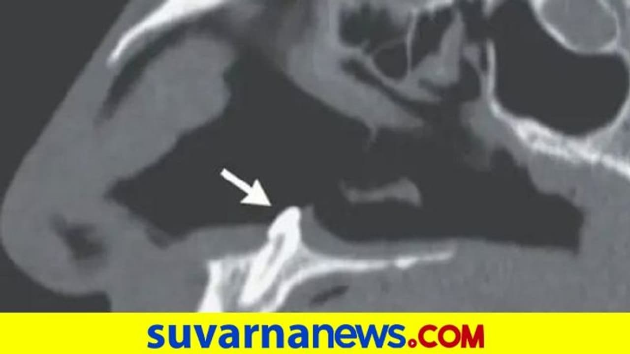 ವರ್ಷದಿಂದ ಉಸಿರಾಟಕ್ಕೆ ಕಷ್ಟ ಪಡುತ್ತಿದ್ದ ವ್ಯಕ್ತಿ... ಎಕ್ಸರೇ ಮಾಡಿದಾಗ ಮೂಗಿನೊಳಗಿದ್ದಿದೇನು ನೋಡಿ