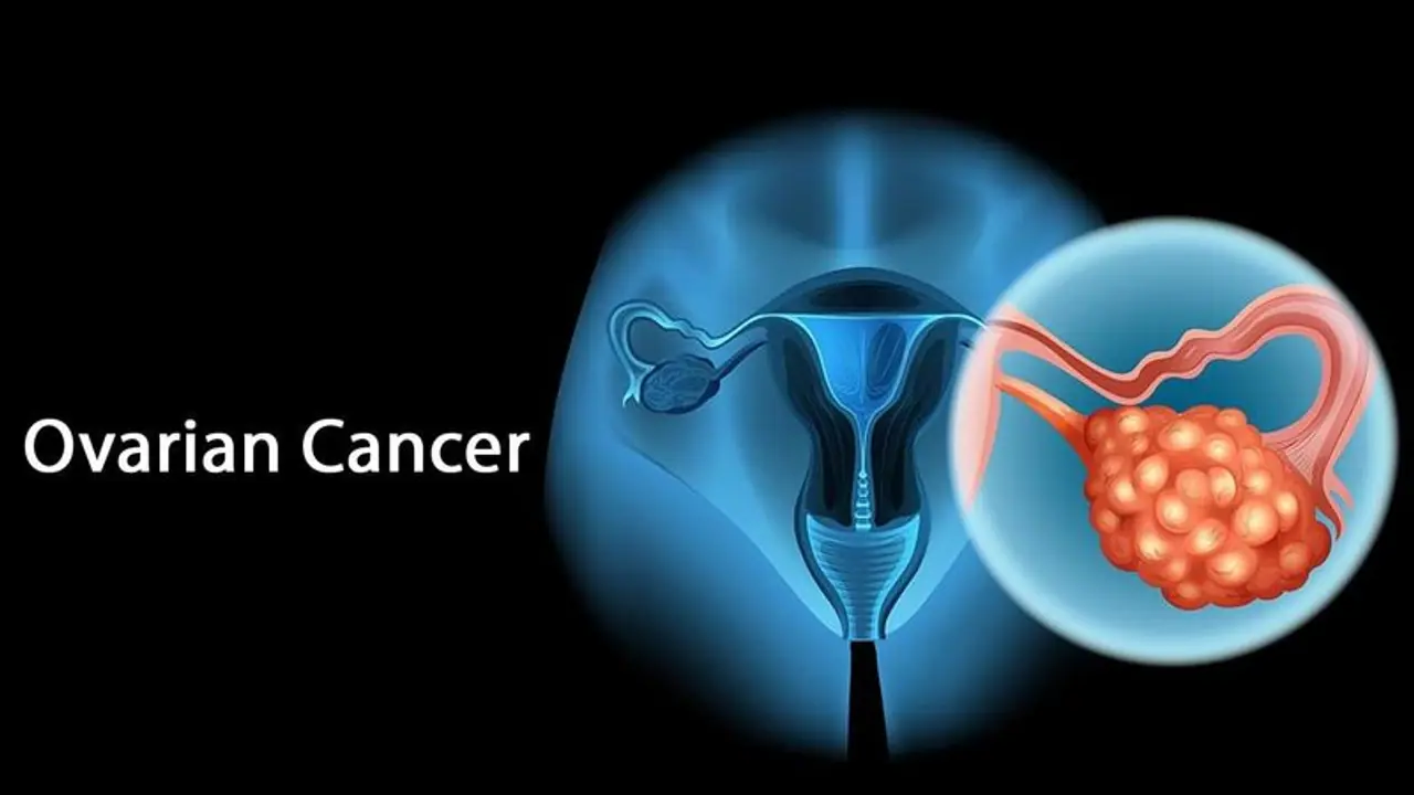 ovarian cancer ovarian cancer