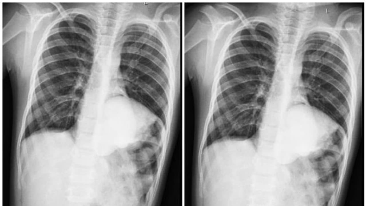 keyhole surgery : വയറിന്റെ ഇടത് ഭാഗത്ത് കഠിനമായ വേദന, ഇടയ്ക്കിടെ ഛർദ്ദിയും; പരിശോധനയിൽ കണ്ടത്...