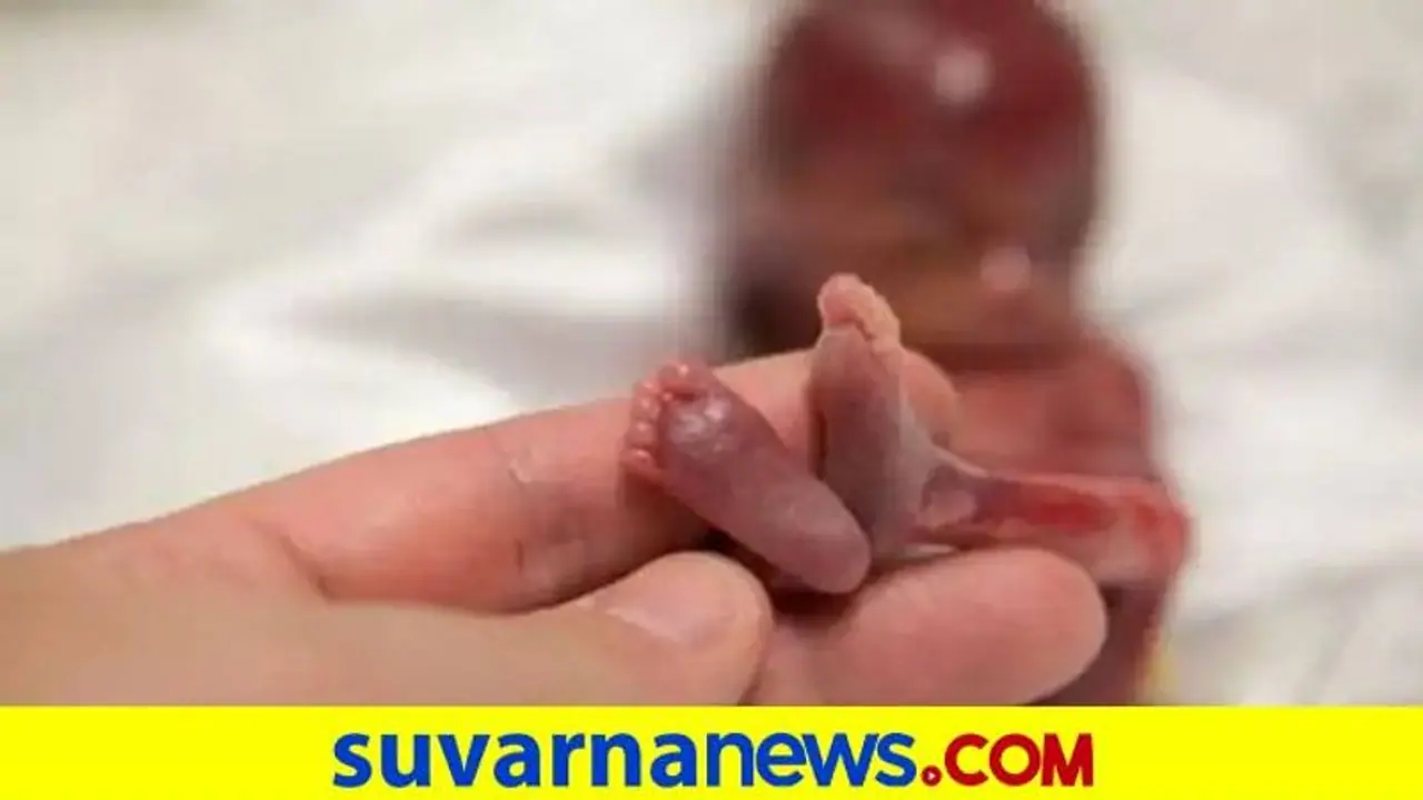 40 ದಿನದ ಶಿಶುವಿನ ಹೊಟ್ಟೆಯಲ್ಲಿ ಭ್ರೂಣ, ವೈದ್ಯಲೋಕಕ್ಕೆ ಅಚ್ಚರಿ!