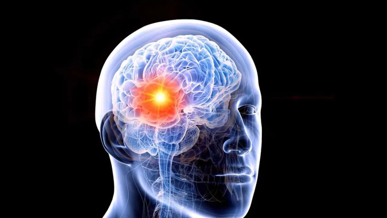 What is Epilepsy? Know some effective strategies for managing THIS neurological disorder What is Epilepsy? Know some effective strategies for managing THIS neurological disorder
