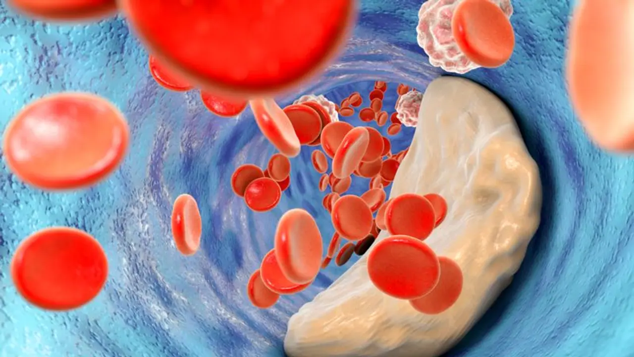 ഉയർന്ന കൊളസ്ട്രോളിന്റെ നാല് പ്രധാനപ്പെട്ട ലക്ഷണങ്ങൾ