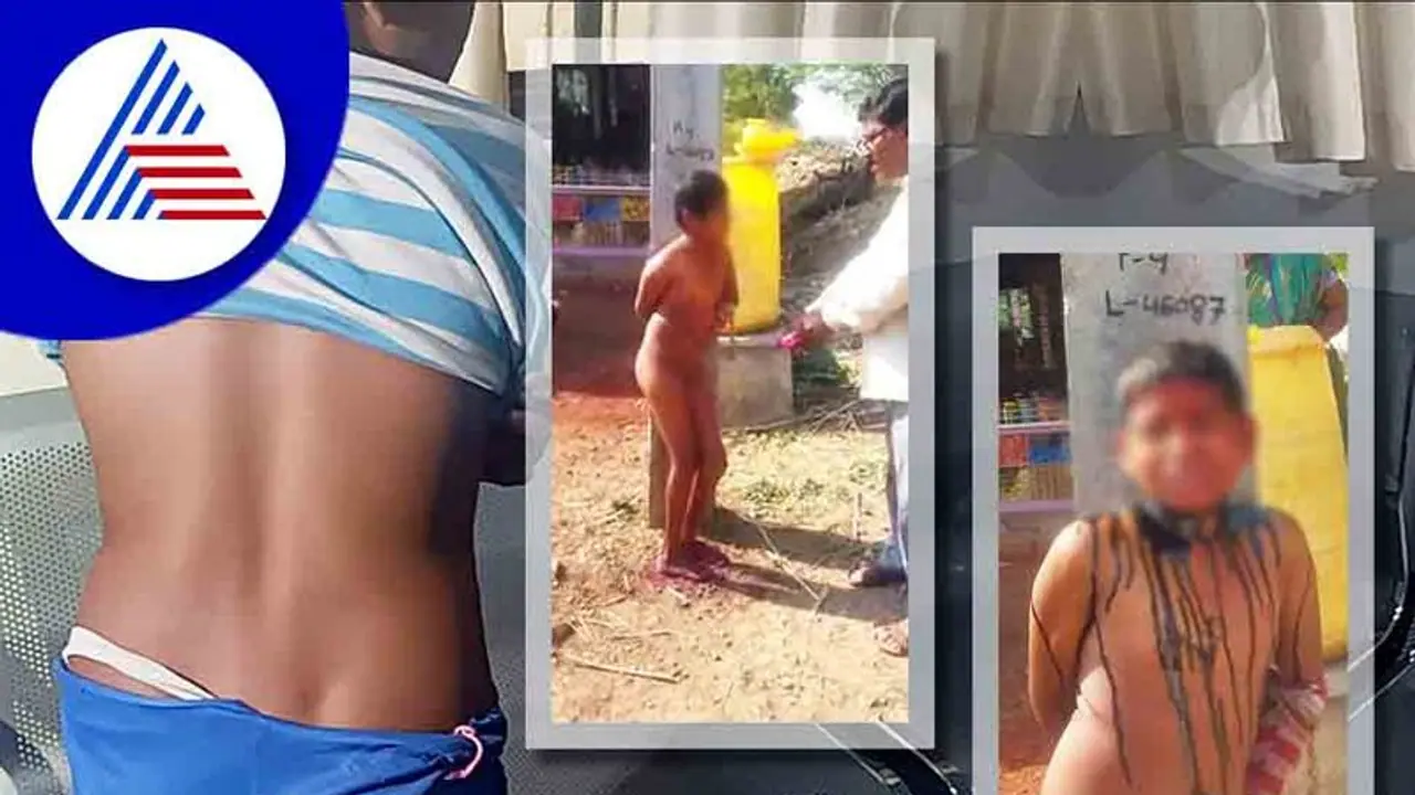 Vijayapura Boy Beaten: ಅಪ್ರಾಪ್ತ ಬಾಲಕನ ಗುಪ್ತಾಗಂಕ್ಕೆ ಬಣ್ಣ ಹಾಕಿ ಹಿಂಸಿಸಿದ ಊರ ಗೌಡ!