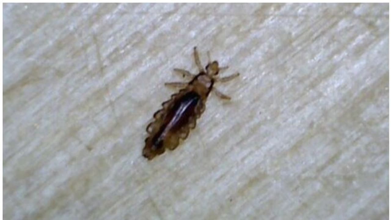 Head Lice : പേൻ ശല്യം അകറ്റാൻ വീട്ടിലുണ്ട് മൂന്ന് പ്രതിവിധികൾ