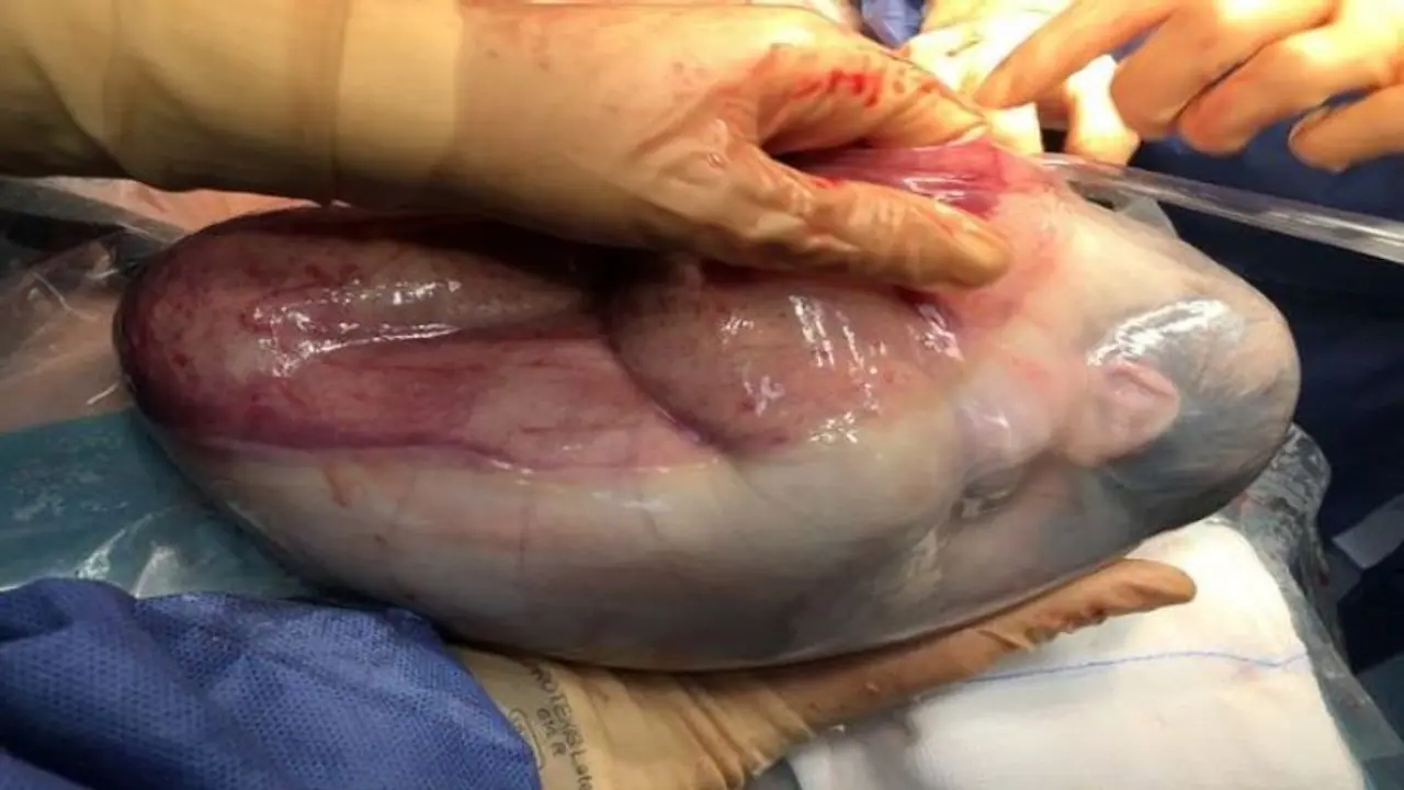 दुर्लभ केस: 'एमनियोटिक थैली' के साथ पैदा हुईं जुड़वा बच्चियां, सोशल मीडिया पर वायरल हो रही इनकी फोटो और वीडियो दुर्लभ केस: 'एमनियोटिक थैली' के साथ पैदा हुईं जुड़वा बच्चियां, सोशल मीडिया पर वायरल हो रही इनकी फोटो और वीडियो