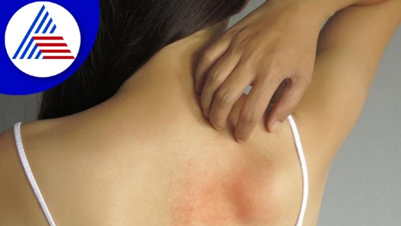 ಬೇಸಿಗೆಯಲ್ಲಿ ಕಾಟ ಕೊಡೋ ಬೆವರುಗುಳ್ಳೆ ಬರದಿರಲು ಹೀಗೆ ಮಾಡಿ ಸಾಕು