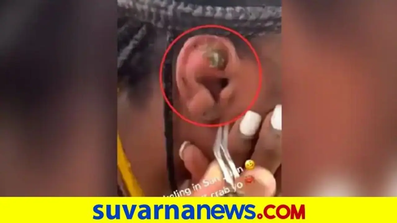 ಮಹಿಳೆಯ ಕಿವಿ ಒಳಗಿಂದ ಹೊರಬಂದ ಏಡಿ ಮರಿ... ವಿಡಿಯೋ ನೋಡಿ