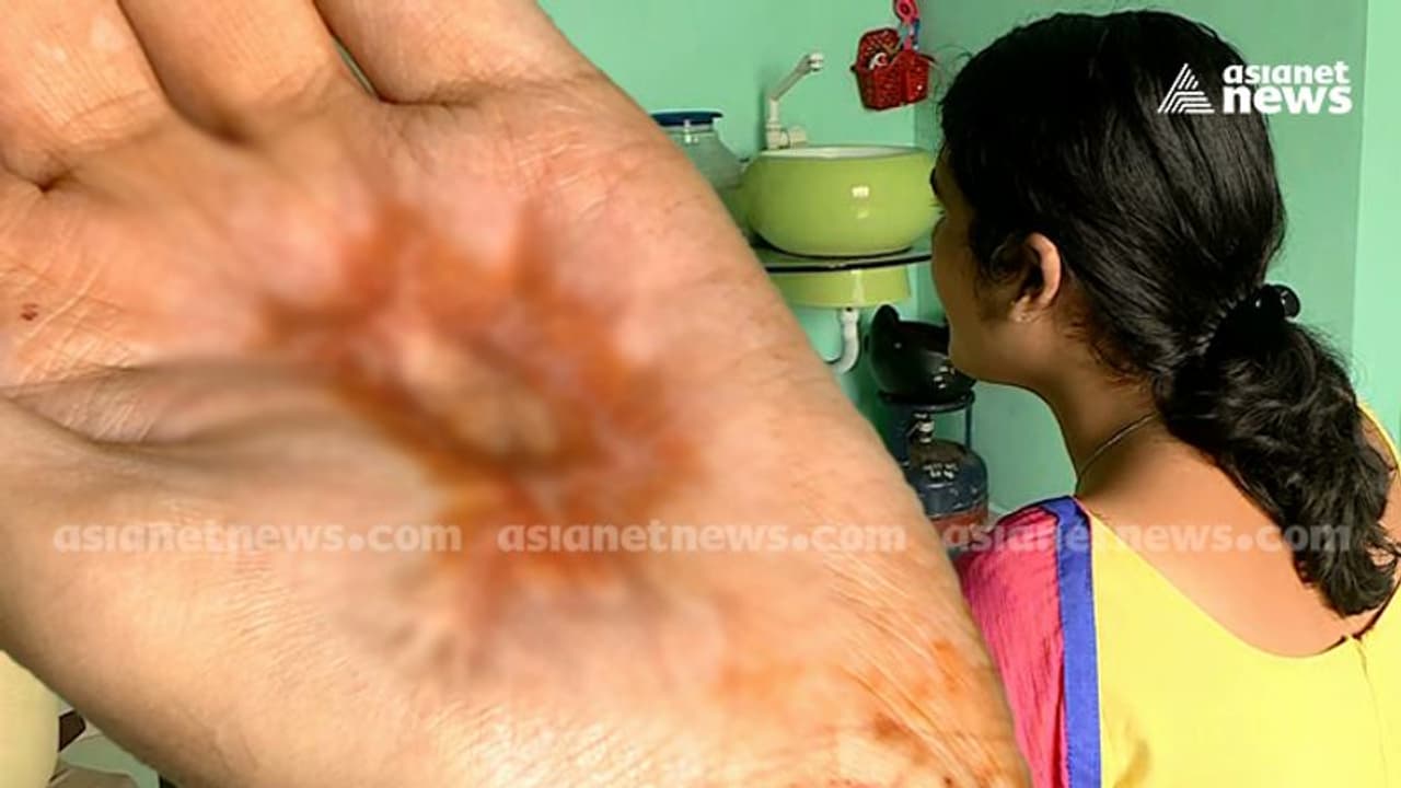 'ദേഹത്ത് ബാധുണ്ടെന്ന് പറഞ്ഞു, കയ്യിൽ കർപ്പൂരം വച്ച് കത്തിച്ചു'; പരാതിയുമായി ട്രാൻസ് യുവതി 'ദേഹത്ത് ബാധുണ്ടെന്ന് പറഞ്ഞു, കയ്യിൽ കർപ്പൂരം വച്ച് കത്തിച്ചു'; പരാതിയുമായി ട്രാൻസ് യുവതി