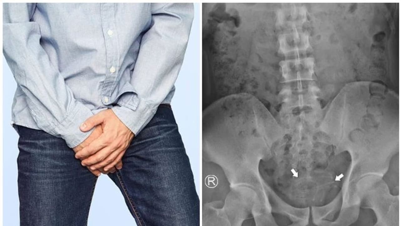 ലിംഗത്തിൽ ഇയർഫോണിന്റെ വയർ തിരുകിക്കയറ്റി യുവാവ്; മണിക്കൂറുകൾക്ക് ശേഷം സംഭവിച്ചത് ലിംഗത്തിൽ ഇയർഫോണിന്റെ വയർ തിരുകിക്കയറ്റി യുവാവ്; മണിക്കൂറുകൾക്ക് ശേഷം സംഭവിച്ചത്