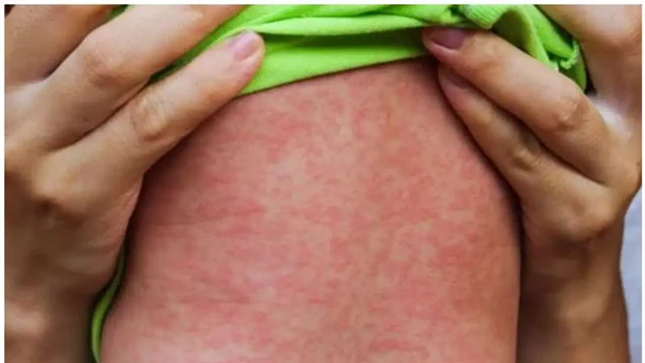 അമേരിക്കയിൽ ഒരു പതിറ്റാണ്ടിന് ശേഷം വീണ്ടും അഞ്ചാം പനി മരണം; വാക്സിനെടുക്കാത്ത കുട്ടി മരിച്ചെന്ന് സ്ഥിരീകരണം