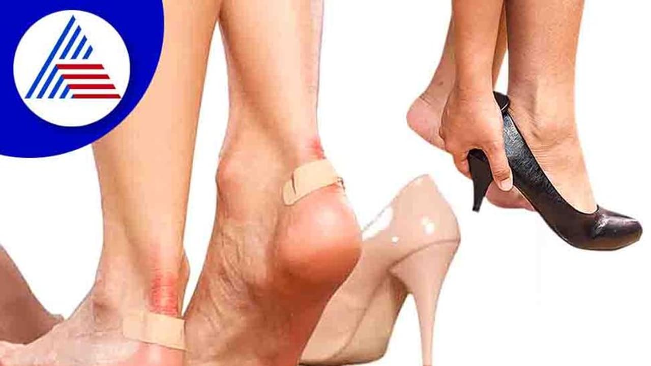 Home Remedies : ಚಪ್ಪಲಿ ಕಚ್ಚಿ ಗಾಯವಾಗಿದ್ಯಾ? ಹಾಗಿದ್ರೆ ಈ ಟಿಪ್ಸ್ ಬಳಸಿ