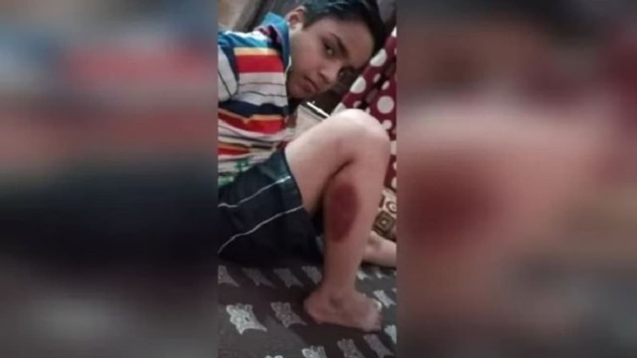 खूंखार कुत्तों के आतंक से भाजपा नेता का बेटा बुरी तरह से हुआ घायल, लोगों में अफसरों के प्रति गुस्सा