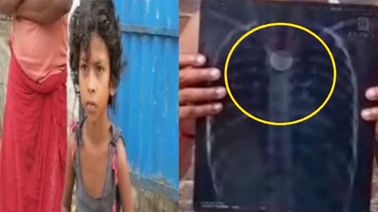 खेल खेल में सिक्का निगल गई मासूम, चार साल तक सीने में फंसा रहा फिर जो हुआ वो चमत्कार से कम नहीं