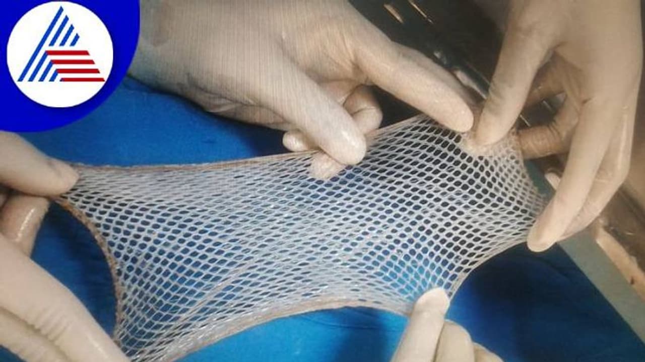 Bengaluru: ಆ್ಯಸಿಡ್ ಸಂತ್ರಸ್ತೆಗೆ ವಿಕ್ಟೋರಿಯಾ ಸ್ಕಿನ್ ಬ್ಯಾಂಕ್‌ನಿಂದ ಚರ್ಮ ರವಾನೆ..!