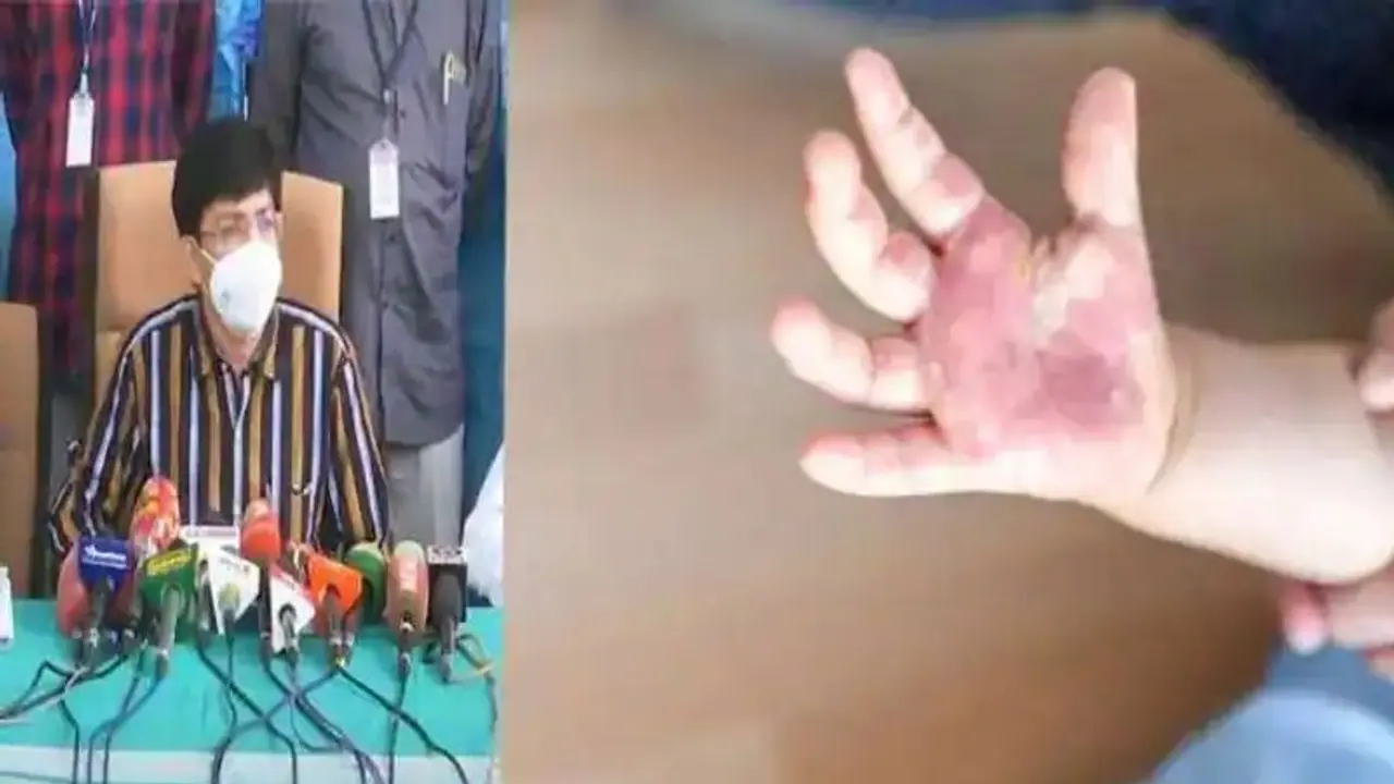 கேரளாவில் பரவும் தக்காளி வைரஸ்.. தக்காளில் இருந்து வைரஸ் பரவுமா..? சுகாதாரத்துறை செயலர் விளக்கம்.. கேரளாவில் பரவும் தக்காளி வைரஸ்.. தக்காளில் இருந்து வைரஸ் பரவுமா..? சுகாதாரத்துறை செயலர் விளக்கம்..