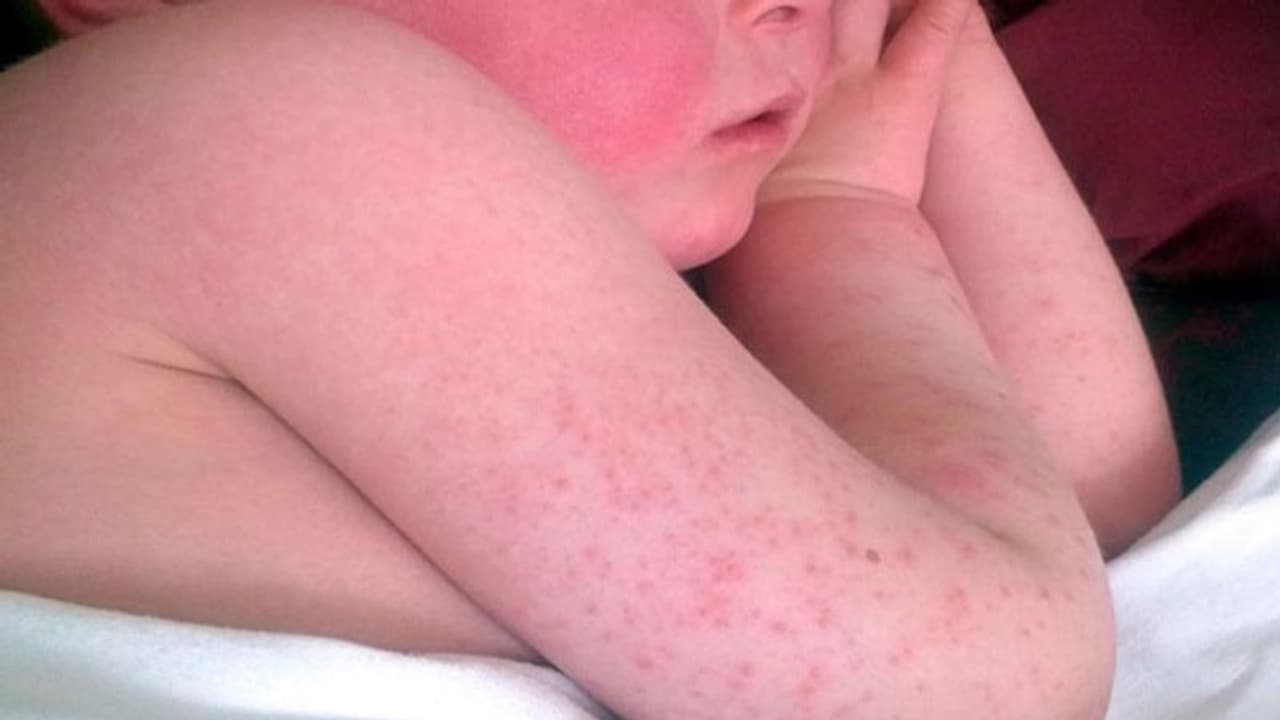 Tomato Flu : തക്കാളിപ്പനി കൂടുതൽ കേരളത്തില്‍; ബാധിക്കുന്നത് 5 വയസിന് താഴെയുള്ള കുട്ടികളെ