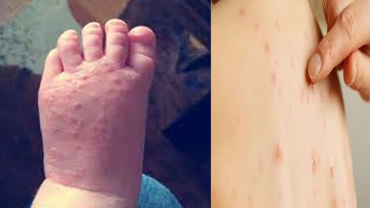 Tomato Fever Symptoms:तेज बुखार समेत ये हैं टोमैटो फीवर के 5 खतरनाक लक्षण Tomato Fever Symptoms:तेज बुखार समेत ये हैं टोमैटो फीवर के 5 खतरनाक लक्षण