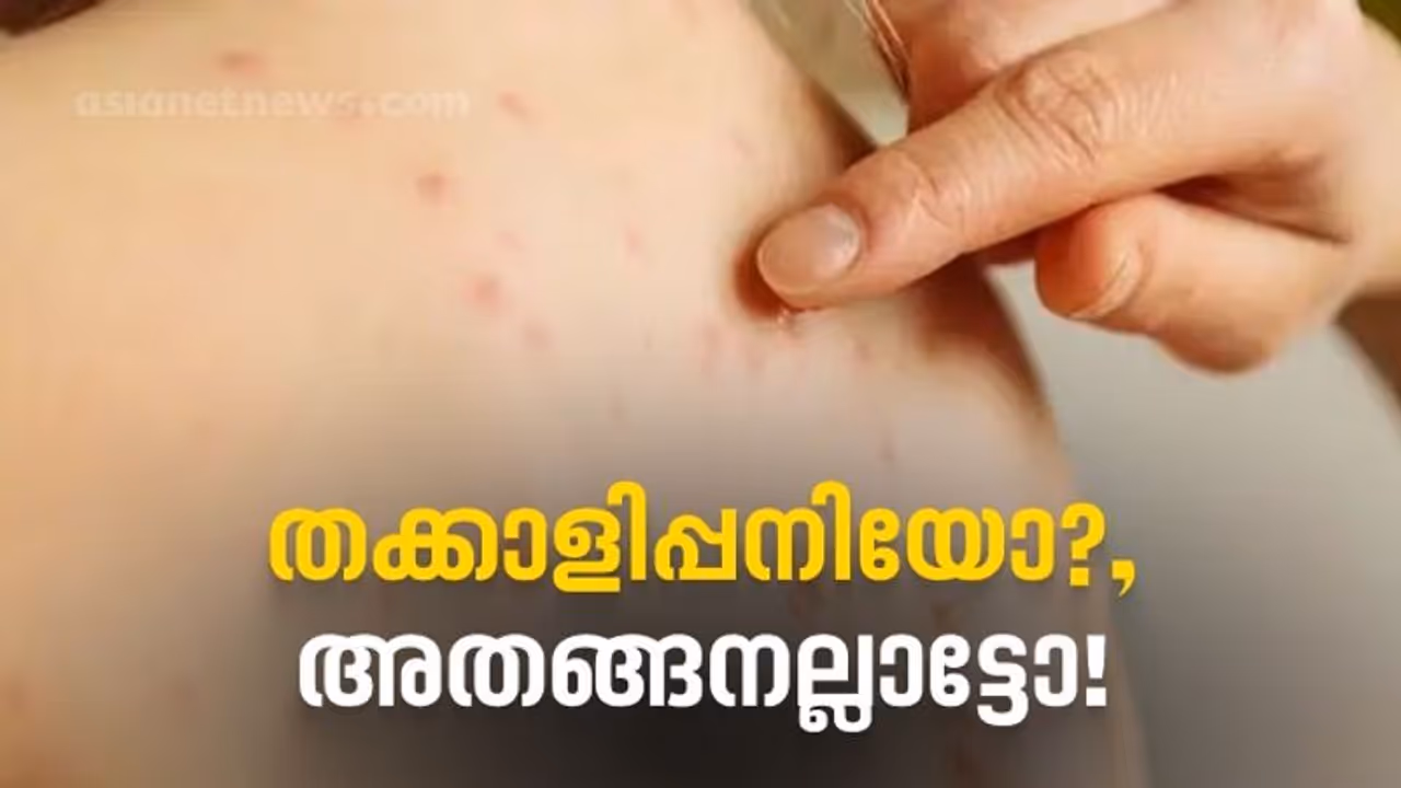 തക്കാളി പനി അഥവാ ഹാന്ഡ് ഫൂട്ട് മൗത്ത് ഡിസീസ്: ലക്ഷണം, ചികിത്സ, പരിചരണം അറിയേണ്ടതെല്ലാം തക്കാളി പനി അഥവാ ഹാന്ഡ് ഫൂട്ട് മൗത്ത് ഡിസീസ്: ലക്ഷണം, ചികിത്സ, പരിചരണം അറിയേണ്ടതെല്ലാം