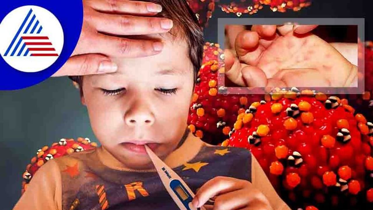 ಮಕ್ಕಳನ್ನು ಕಾಡುತ್ತಿದೆ ಟೊಮೆಟೊ ಜ್ವರ, ರೋಗ ಲಕ್ಷಣಗಳು ಯಾವುವು ? ಚಿಕಿತ್ಸೆಯೇನು ?