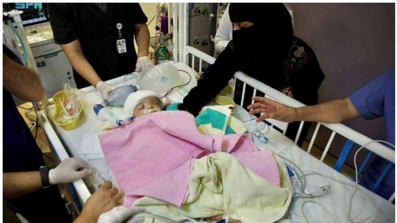 15 മണിക്കൂര്‍ നീണ്ട ശസ്ത്രക്രിയ വിജയം; സയാമീസ് ഇരട്ടകളായ യൂസുഫിനും യാസീനും ഇനി വേറിട്ട ജീവിതങ്ങള്‍