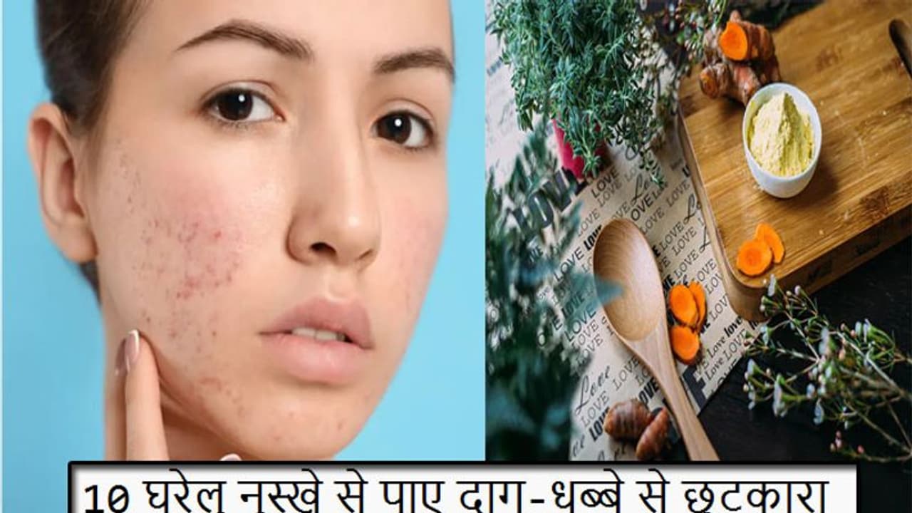 मुंहासों और दाग धब्बों को इन 10 घरेलू नुस्खे से कर सकती हैं दूर, बिना किसी खर्चे के मिलेगा फ्लॉलेस स्किन