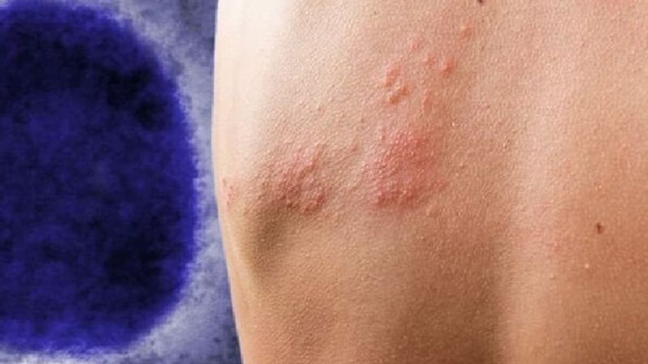 Monkeypox Virus : മങ്കിപോക്സും സെക്സും തമ്മില്‍ എന്ത് ബന്ധം?