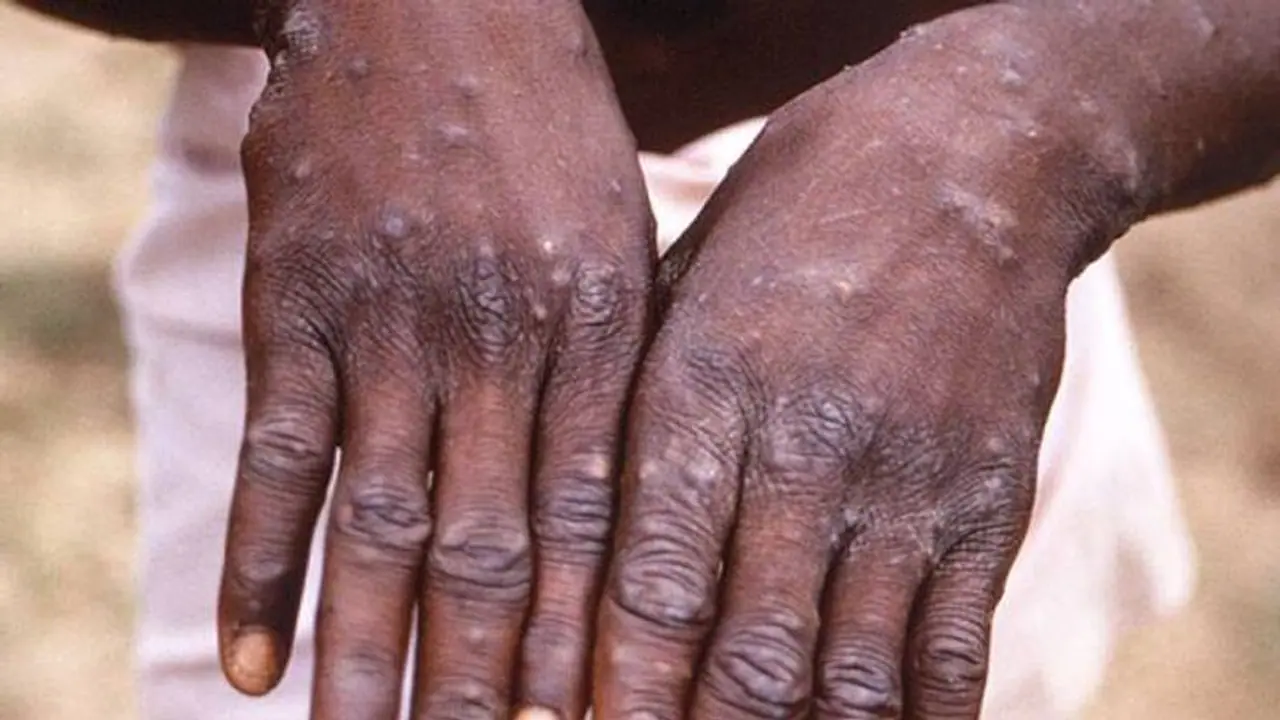 Monkeypox : കുരങ്ങുപനി ; രോഗികളുടെ എണ്ണം ഇനിയും വർദ്ധിച്ചേക്കാമെന്ന് ലോകാരോ​ഗ്യ സംഘടന