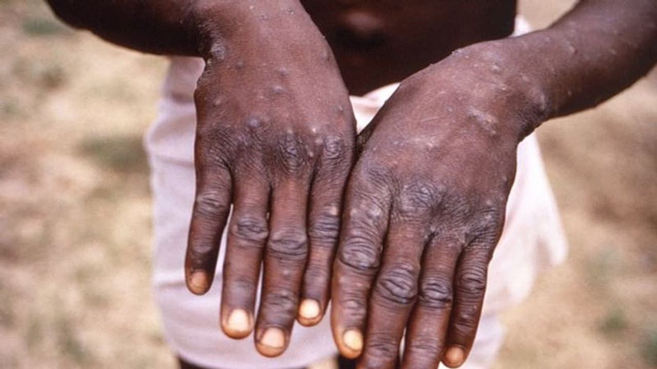 Monkeypox : യുകെയിൽ 77 മങ്കിപോക്സ് കേസുകള്‍ കൂടി കണ്ടെത്തി; രോഗബാധിതരുടെ എണ്ണം 302 ആയി