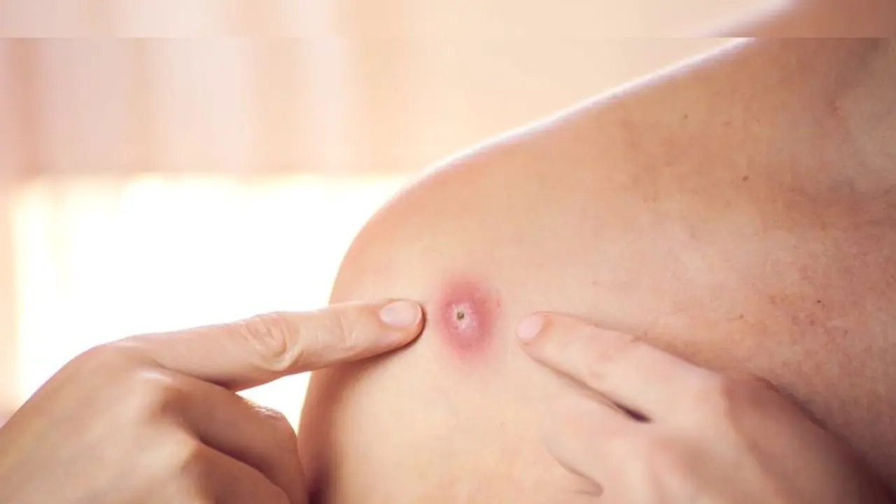 Monkeypox India : ആശങ്ക പരത്തി കുരങ്ങുപനി; ഇത്രയും പേടിക്കേണ്ടതുണ്ടോ?