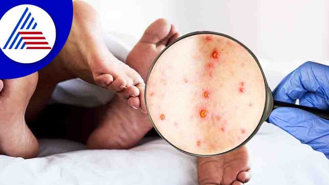 Monkeypox Virus : ശുക്ലത്തില്‍ മങ്കിപോക്സ് വൈറസ് സാന്നിധ്യം; ലൈംഗികരോഗമാണെന്ന വാദം കനക്കുന്നു...